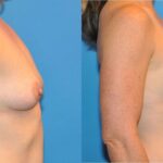 Breast Implant #36 - Before and After