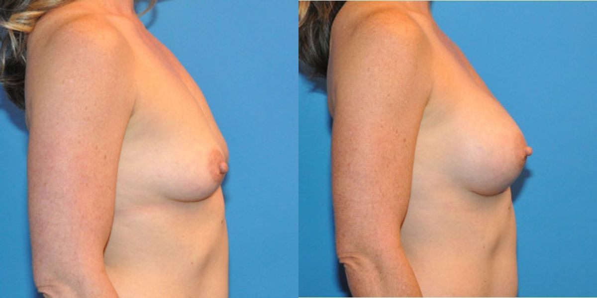 Breast Implant #36 - Before and After