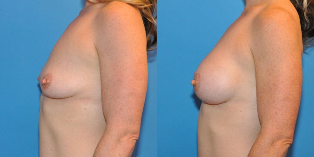 Breast Implant #36 - Before and After
