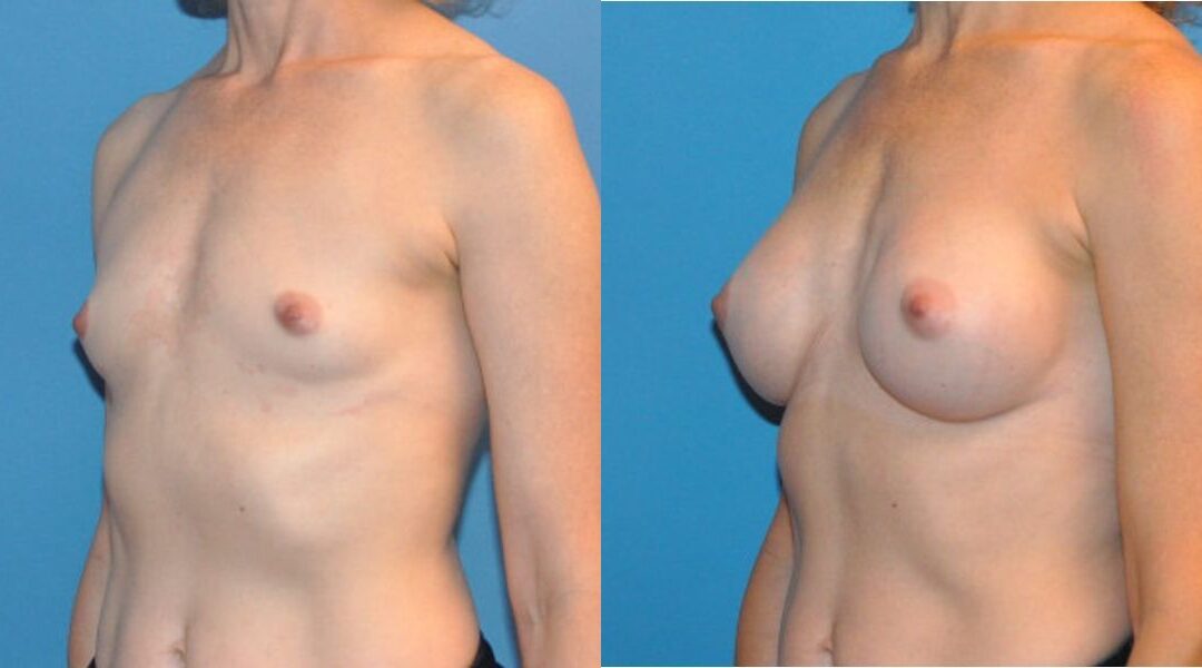 Breast Implant #37