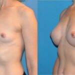 Breast Implant #37 - Before and After