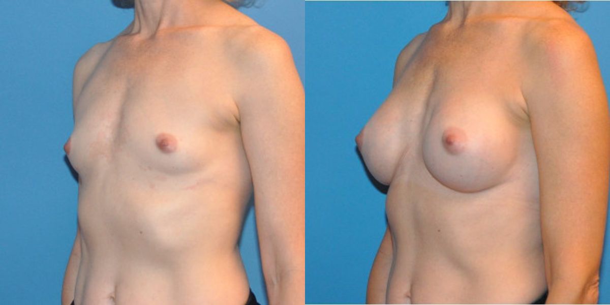 Breast Implant #37 - Before and After