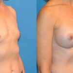 Breast Implant #37 - Before and After