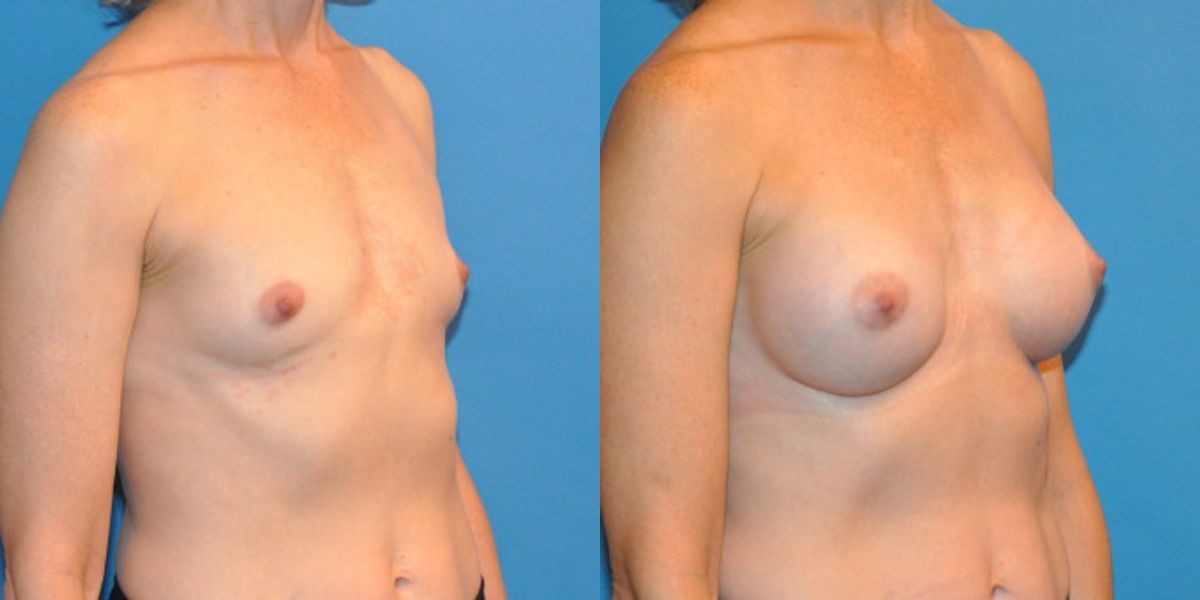 Breast Implant #37 - Before and After