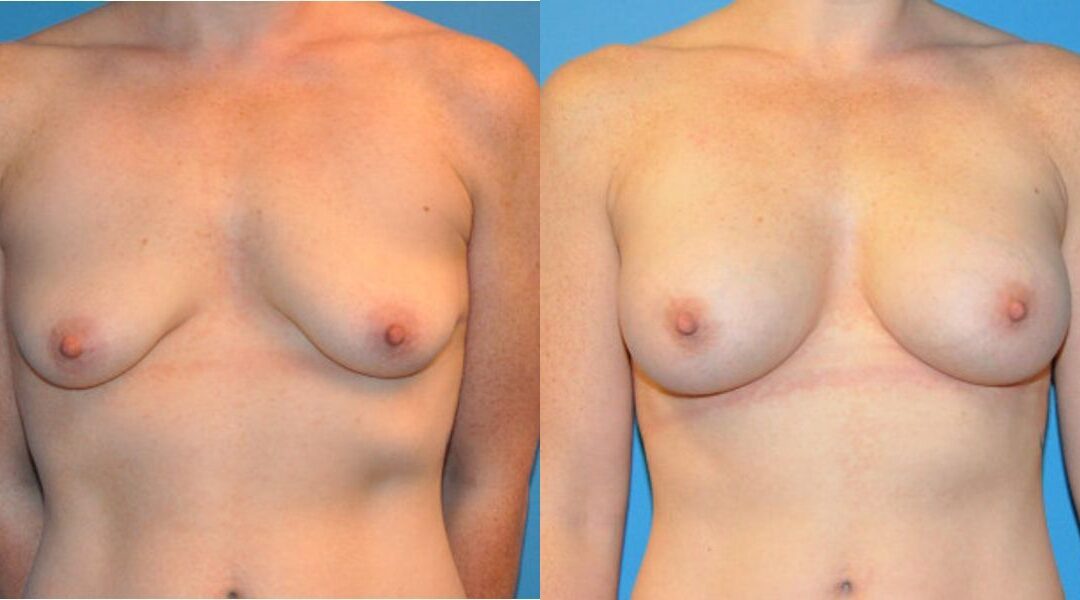 Breast Implant #38