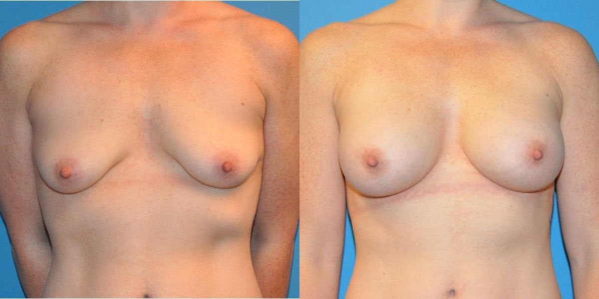 Breast Implant #38 - Before and After