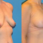 Breast Implant #38 - Before and After