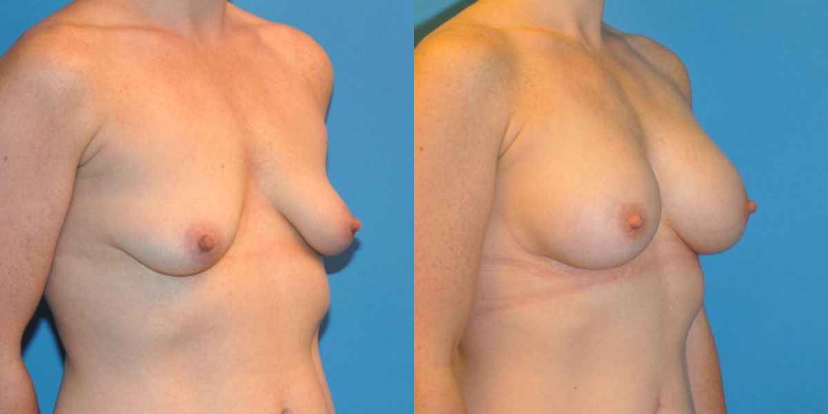 Breast Implant #38 - Before and After