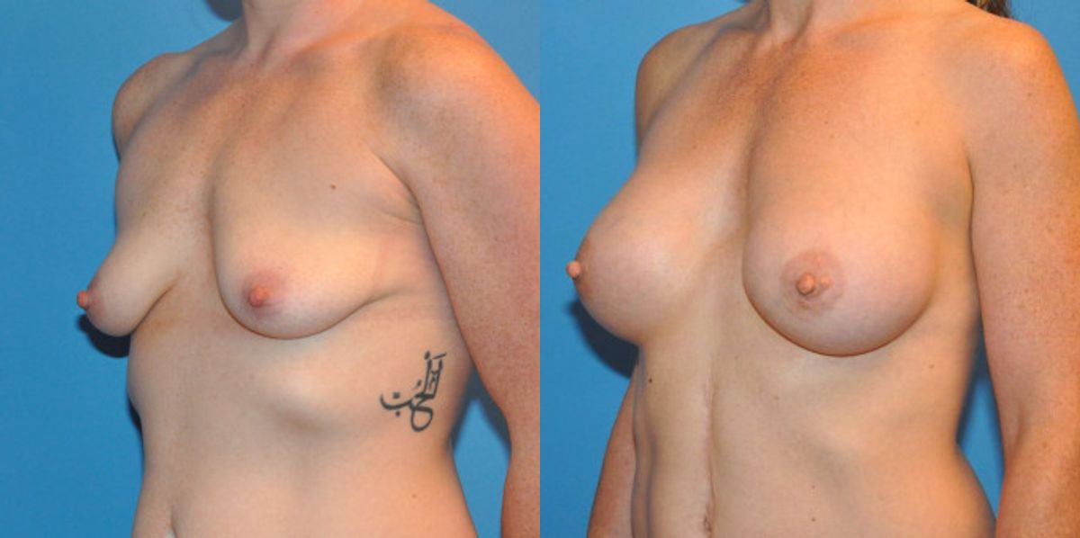 Breast Implant #38 - Before and After