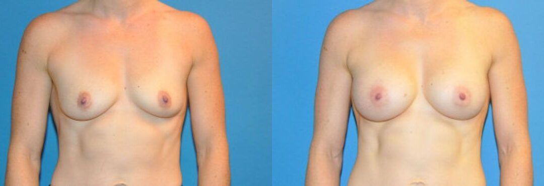 Breast Implant #39