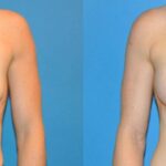 Breast Implant #39 - Before and After