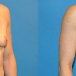 Breast Implant #39 - Before and After