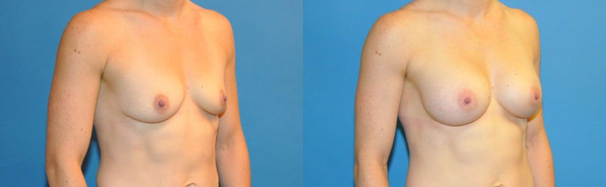 Breast Implant #39 - Before and After