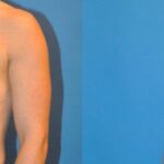 Breast Implant #39 - Before and After