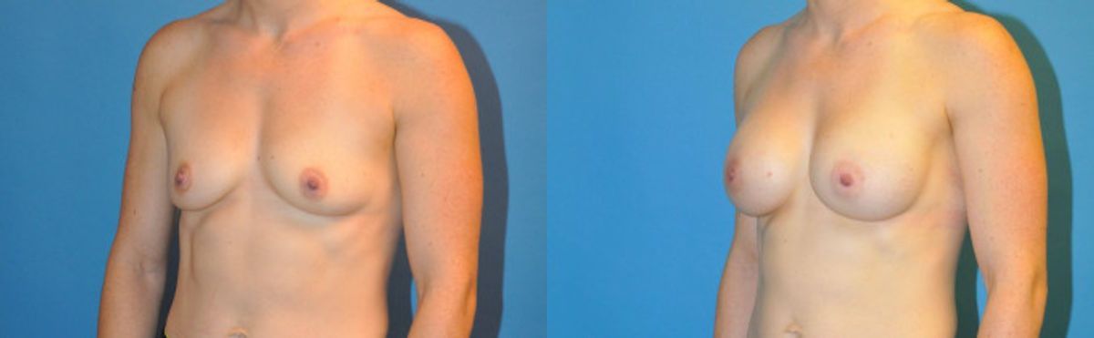 Breast Implant #39 - Before and After