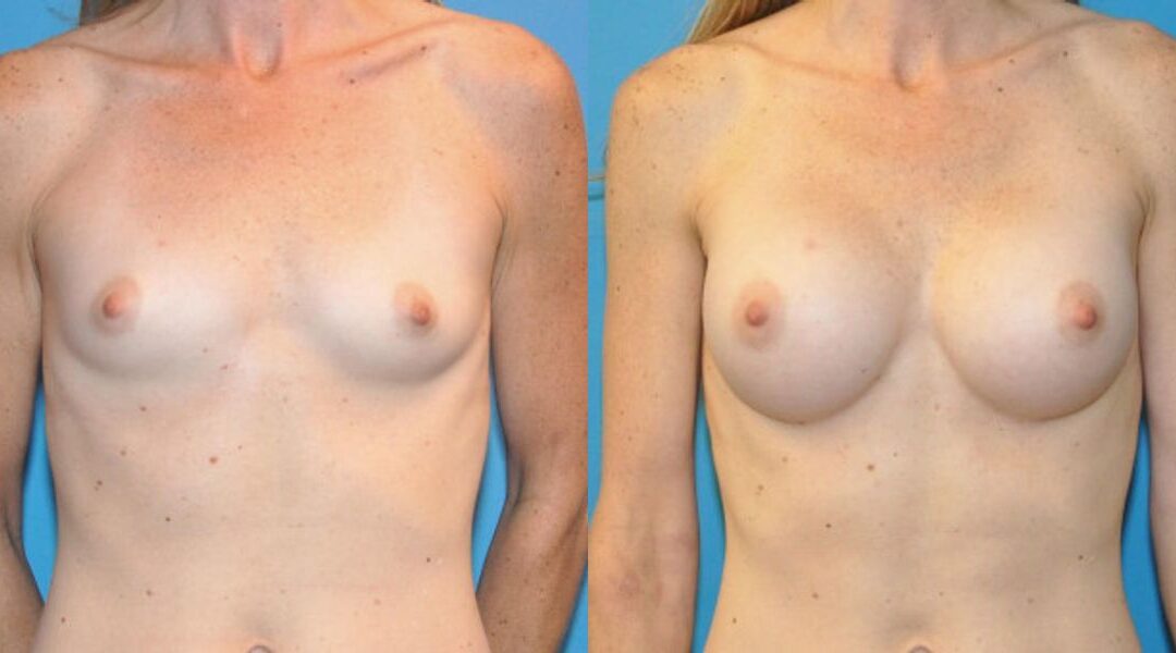 Breast Implant #40