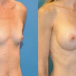 Breast Implant #40 - Before and After
