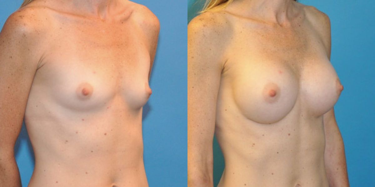 Breast Implant #40 - Before and After