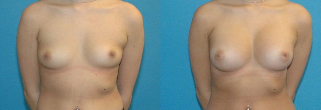 Breast Implant #41