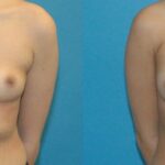 Breast Implant #41 - Before and After