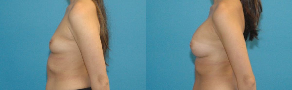 Breast Implant #41 - Before and After