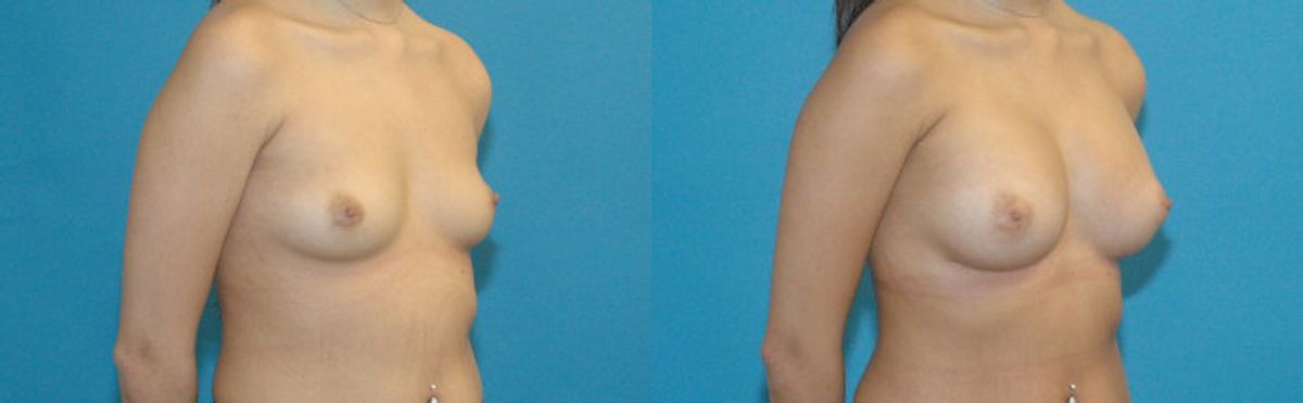 Breast Implant #41 - Before and After
