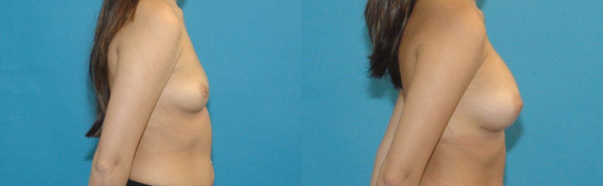 Breast Implant #41 - Before and After