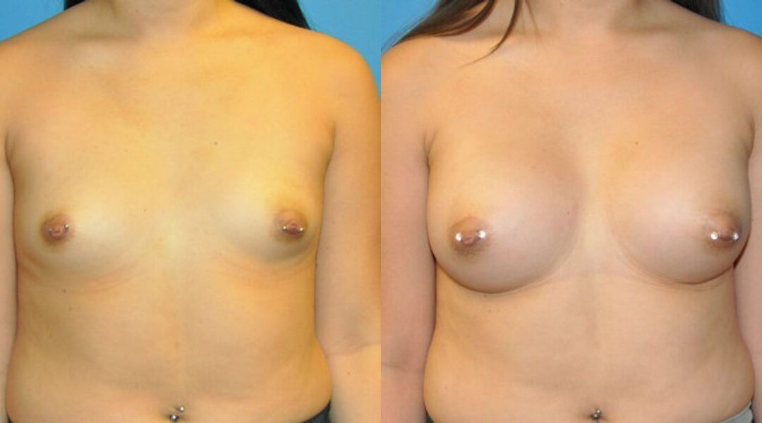 Breast Implant #42