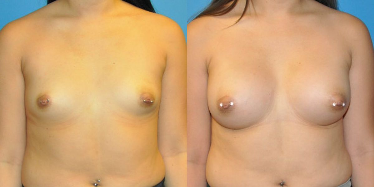 Breast Implant #42 - Before and After