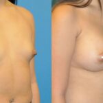 Breast Implant #42 - Before and After