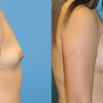 Breast Implant #42 - Before and After