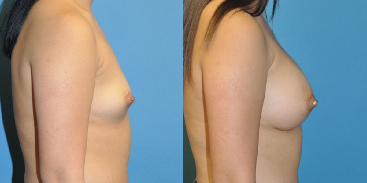 Breast Implant #42 - Before and After