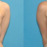 Breast Implant #43 - Before and After