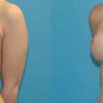 Breast Implant #43 - Before and After