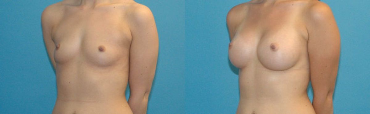 Breast Implant #43 - Before and After