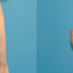 Breast Implant #43 - Before and After