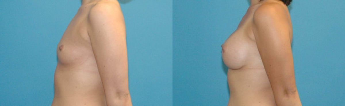 Breast Implant #43 - Before and After