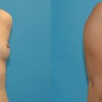 Breast Implant #43 - Before and After