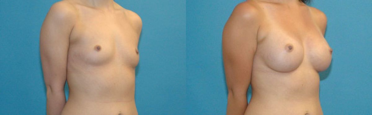 Breast Implant #43 - Before and After