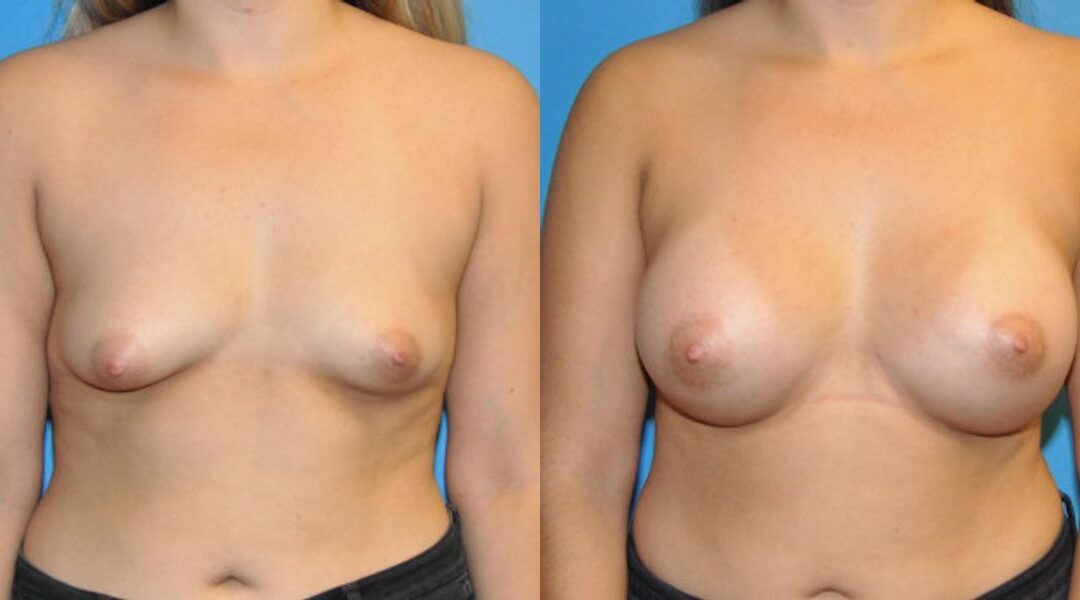 Breast Implant #44