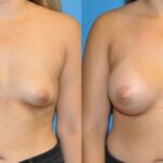 Breast Implant #44 - Before and After