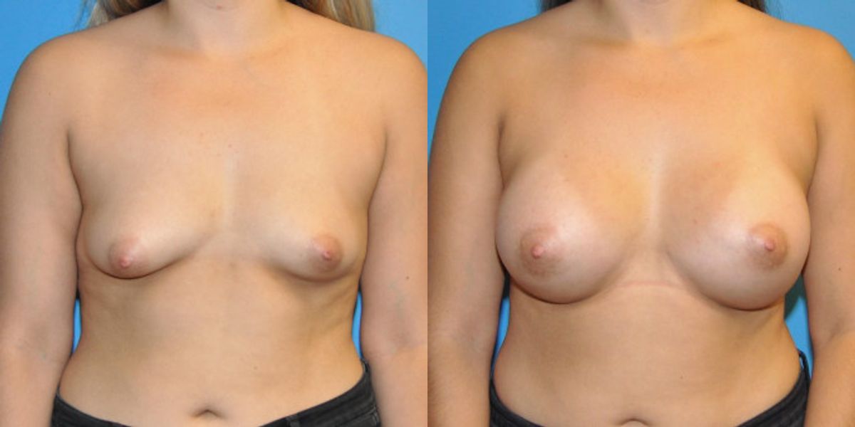 Breast Implant #44 - Before and After