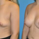 Breast Implant #44 - Before and After