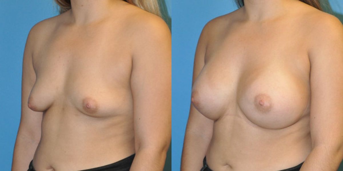Breast Implant #44 - Before and After