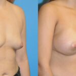 Breast Implant #44 - Before and After