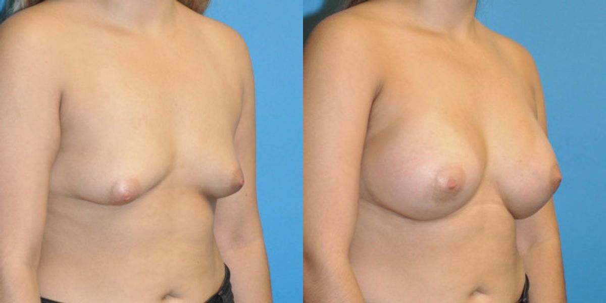 Breast Implant #44 - Before and After