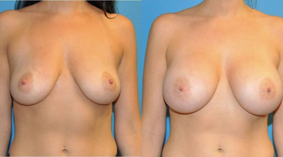 Breast Implant #45