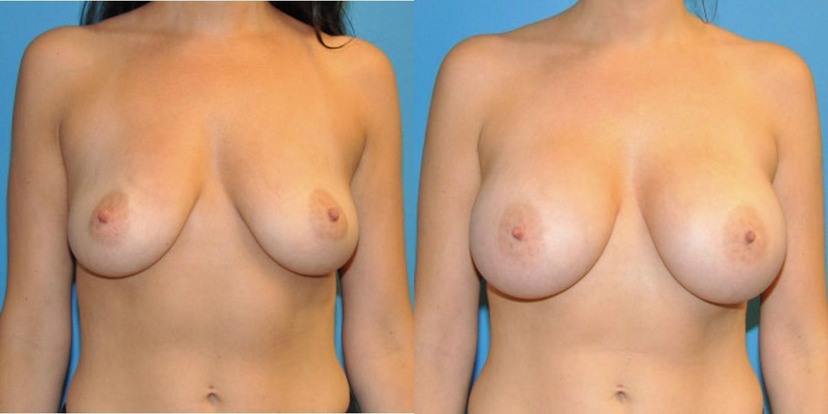 Breast Implant #45 - Before and After