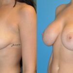 Breast Implant #45 - Before and After
