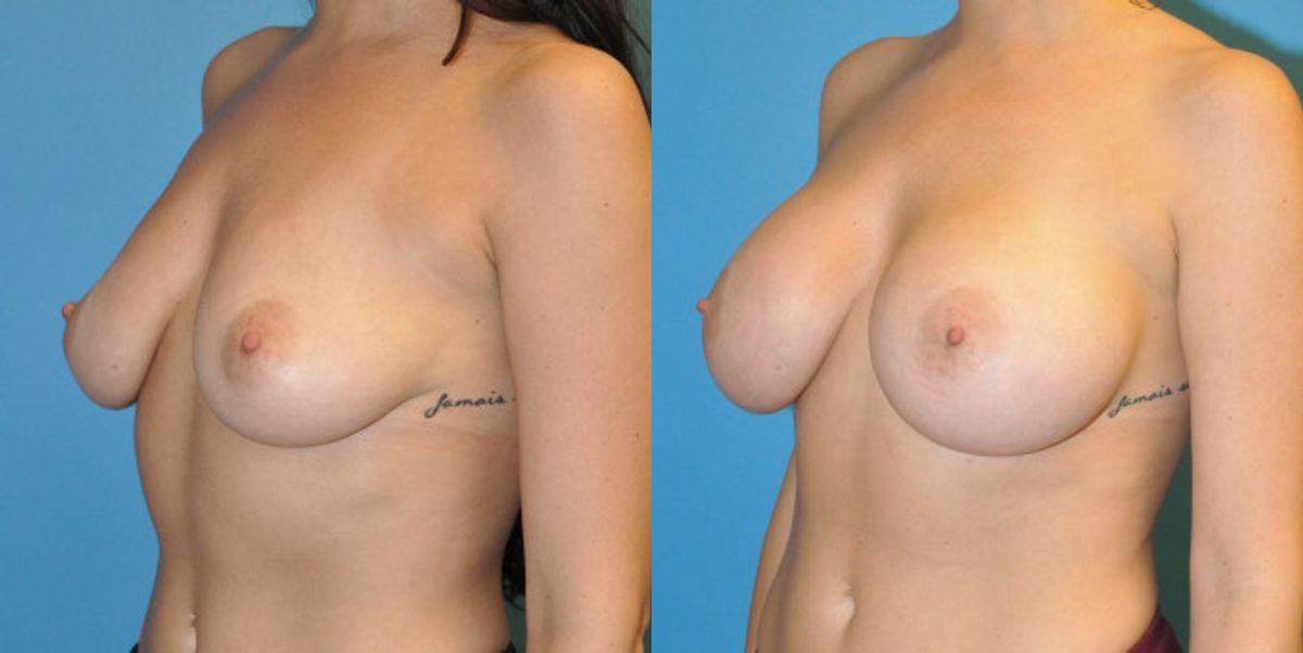 Breast Implant #45 - Before and After